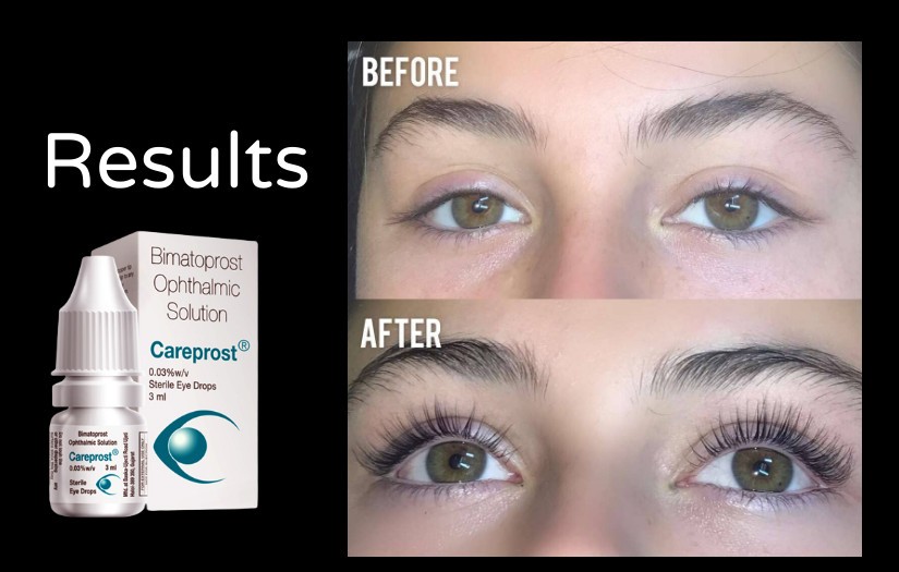 Click image for larger version

Name:	Careprost Result.jpg
Views:	52
Size:	76.6 KB
ID:	12490