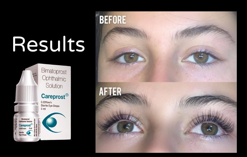 Click image for larger version

Name:	Careprost Result.jpg
Views:	31
Size:	76.6 KB
ID:	12490